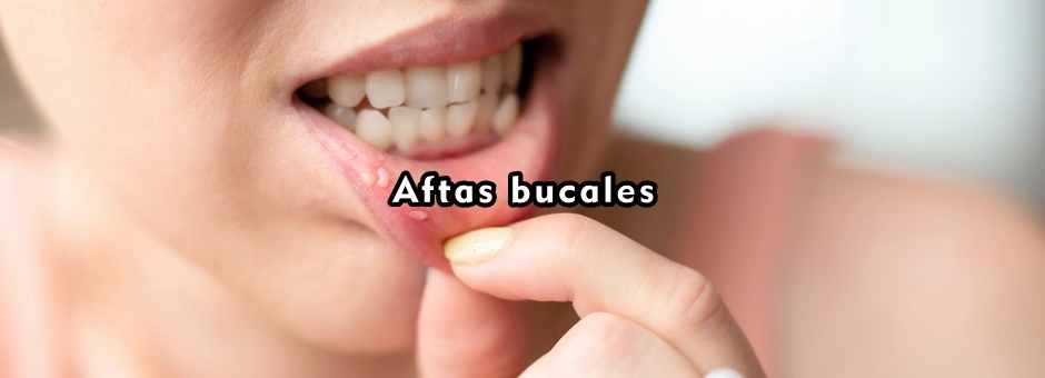 Las aftas bucales