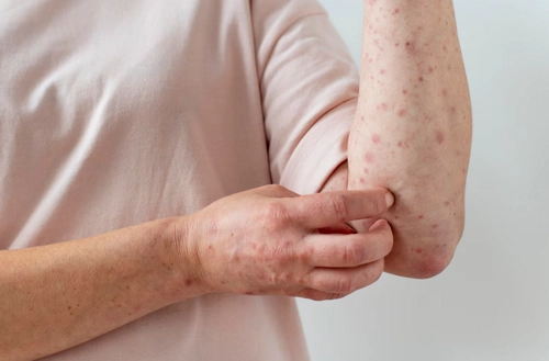 Dermatofitos